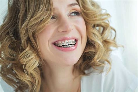 Sparkling Smiles: The Magic of Teeth Braces Revealed